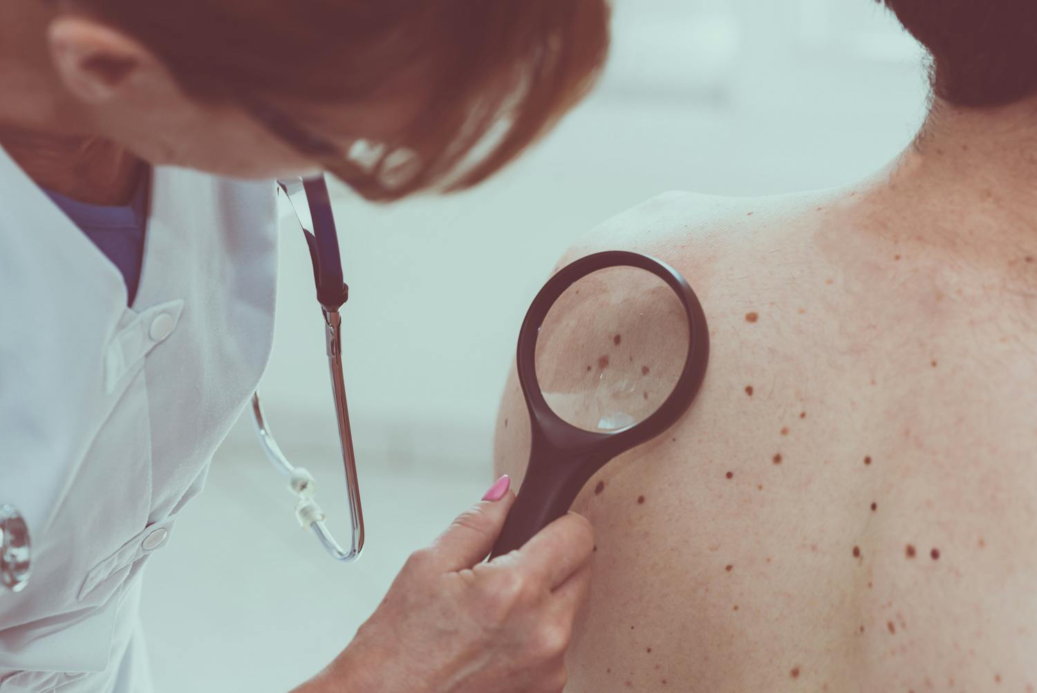 Cancer de la peau : quels sont les symptômes ?