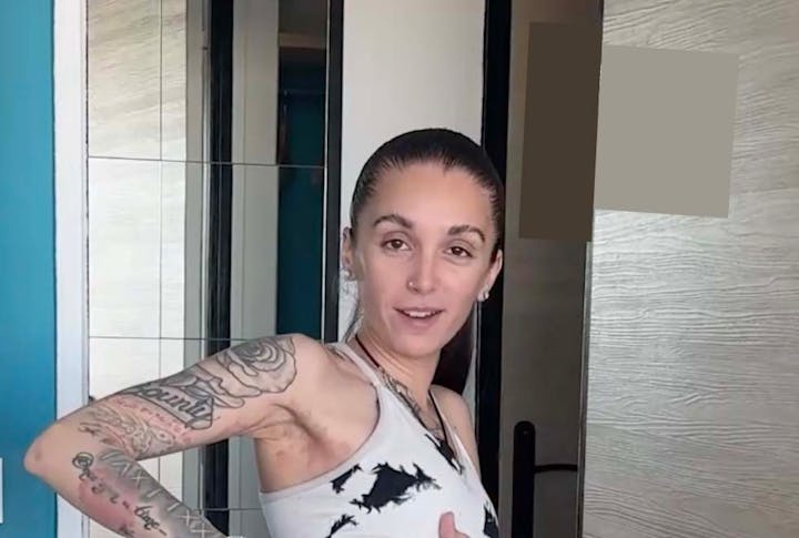 Psoriasis : "On m'a traitée de lépreuse !"