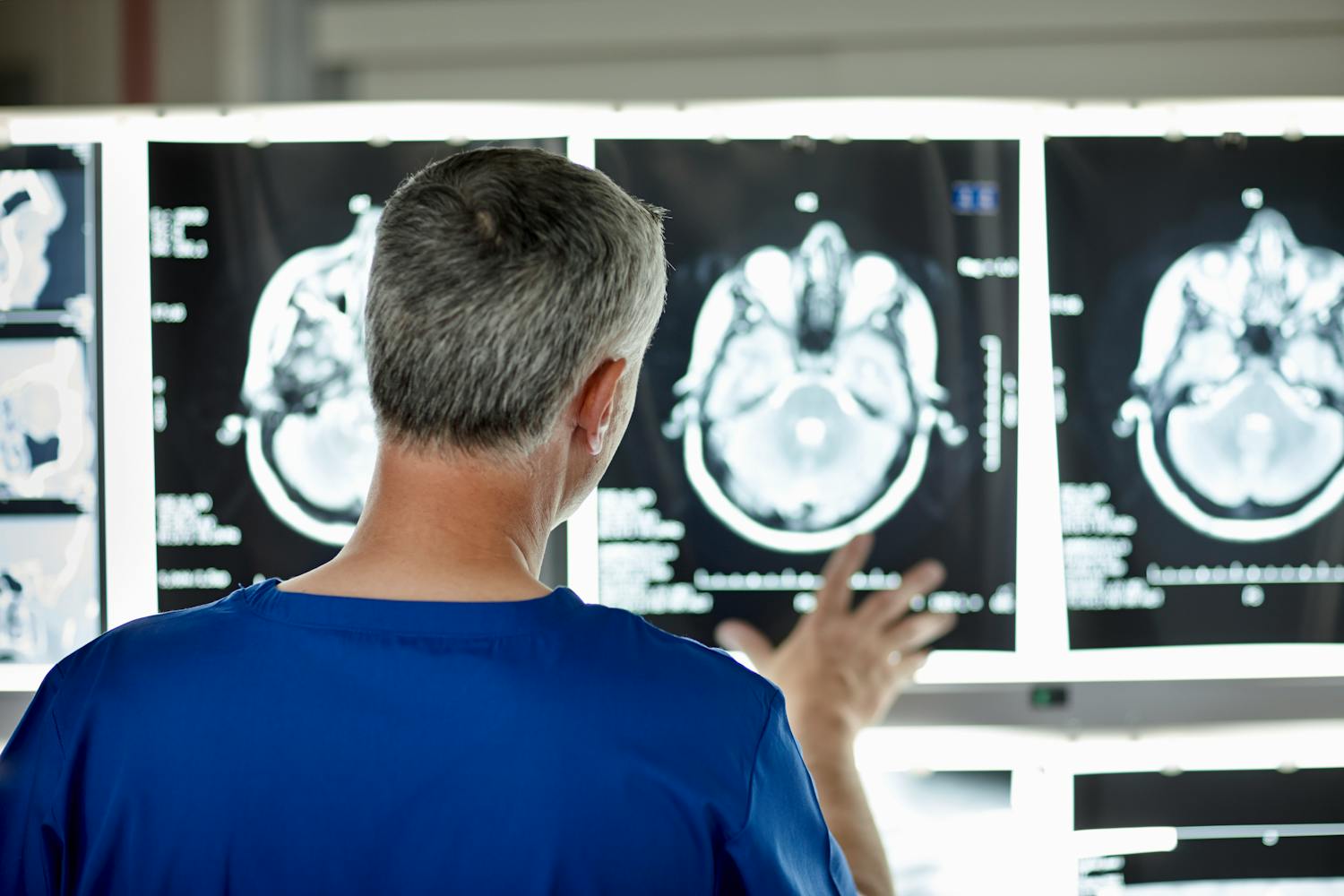 Hématome sous-dural : symptômes, causes et traitements