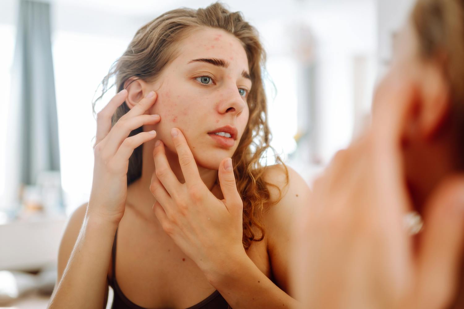 Quels sont les effets du soleil sur l'acné ? Est-il un ami ou un faux ami ?