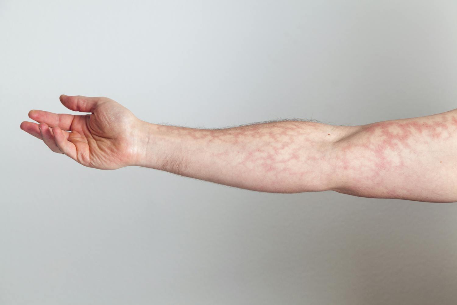 Peau marbrée : faut-il s'inquiéter ?