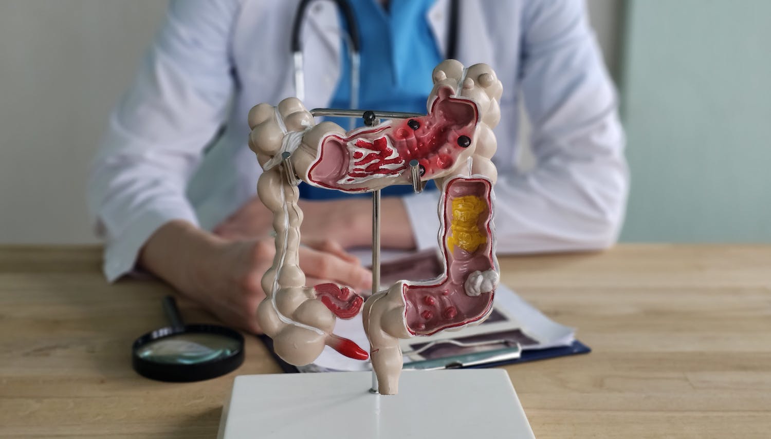 Symptômes : comment commence un cancer du côlon ?