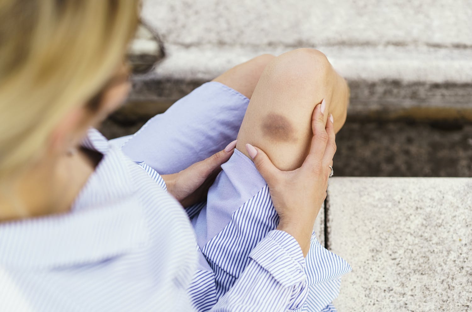 Contusion après un accident de voiture : symptômes, durée, traitements